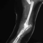 Chance Xray RH leg LAT fracture